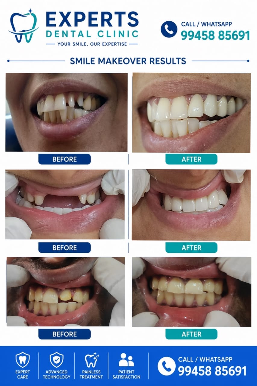 Smile makeover before and after results at Expert's Dental Clinic